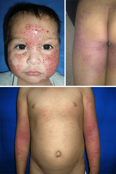 Silcura® AD (atopic dermatitis) - Silcura