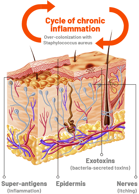 Cycle of Choronic Inflammation - Illustration